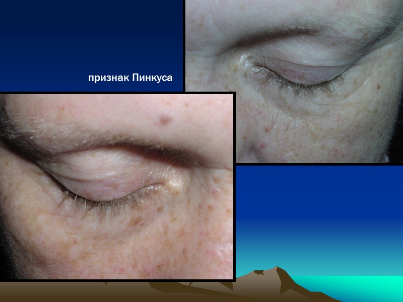 признак Пинкуса